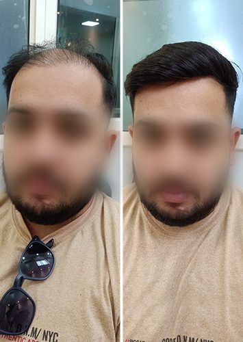 men-hair-replacment3